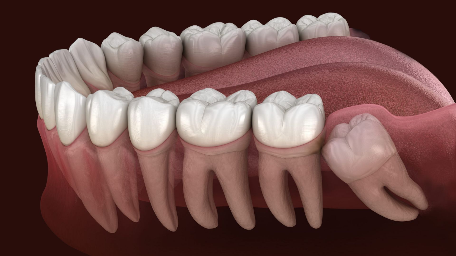 Third Molar Impaction
