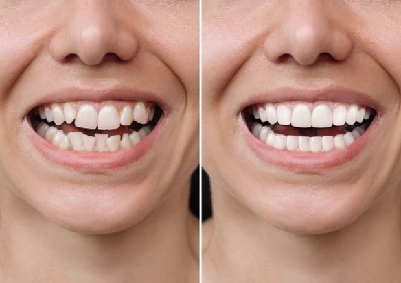 Aligners Treatments